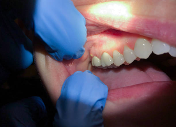 Best Knocked-Out Tooth Emergency  in Ash Grove, MO