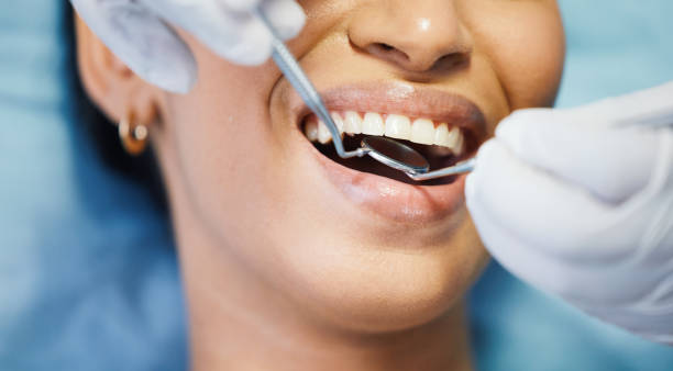Best Chipped Tooth Repair Near Me  in Ash Grove, MO